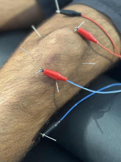 dry needling, therapy, pain, strain, sprain, neck pain, knee pain, shoulder pain, back pain