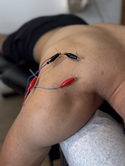 dry needling, plantar fasciitis, strain, pain, sprain, neck pain, shoulder pain, back pain, hip pain